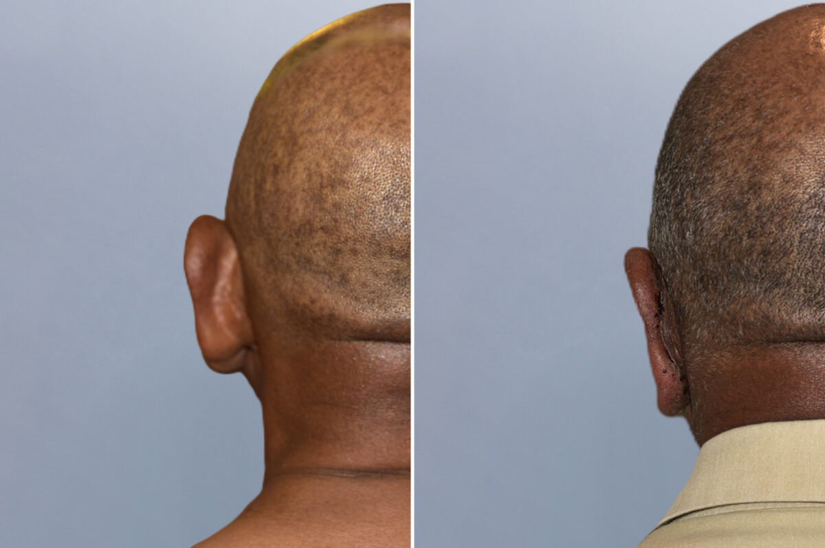 Face Procedures before and after photos in FL, Palm Beach Gardens, Patient 1299