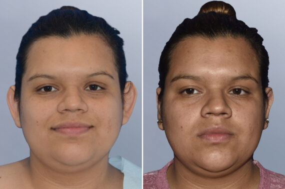 Otoplasty (Ear Pinning) before and after photos in FL, Palm Beach Gardens