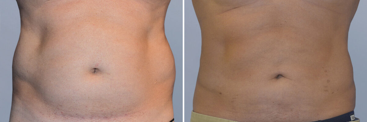 Body Procedures before and after photos in FL, Palm Beach Gardens, Patient 1042