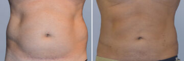 Body Procedures before and after photos in FL, Palm Beach Gardens, Patient 1042