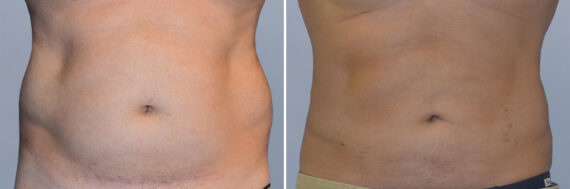 Body Procedures before and after photos in FL, Palm Beach Gardens, Patient 1042