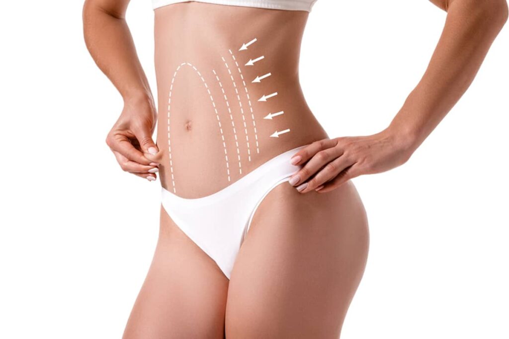 Woman’s abdomen with contour lines illustrating tummy tuck and body-shaping areas.